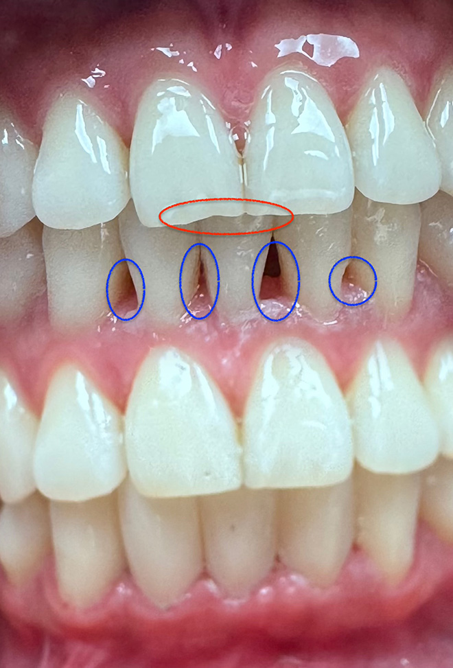 One and Truly Holistic Dental | Periodontal Treatment, Bone Regeneration and Sinus Elevation