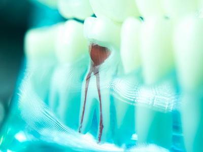 Apicoectomy in Glen Cove