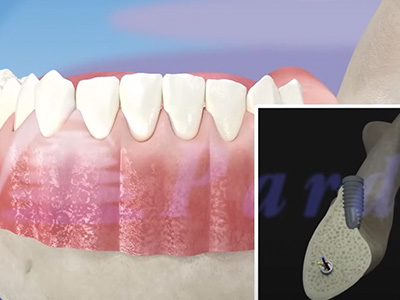 Bone Regeneration in Glen Cove