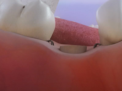 Dental Crown in Glen Cove