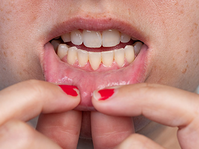 Frenectomy in Glen Cove