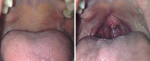 NightLase in Glen Cove