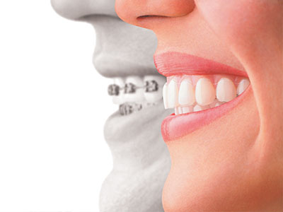 Invisalign vs braces Glen Cove