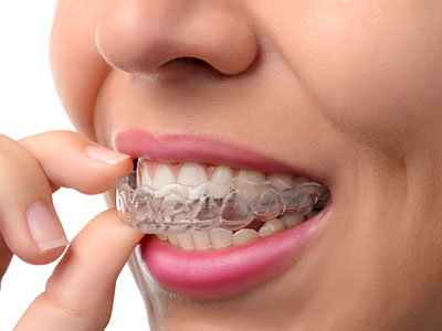 Invisalign vs Consumer in Glen Cove