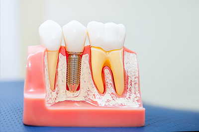 Dental Implants in Glen Cove