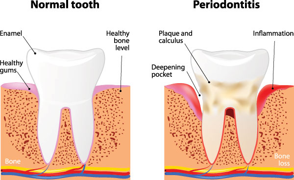 Periodontal Treatment in Glen Cove
