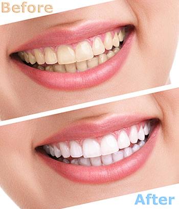 Teeth whitening in Glen Cove