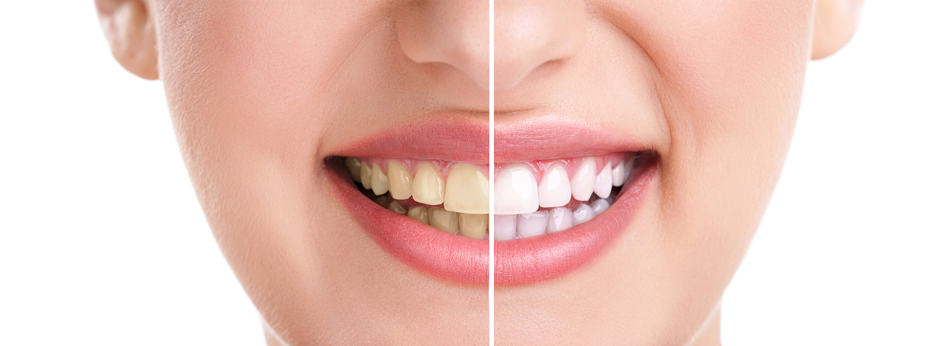 Teeth whitening in Glen Cove